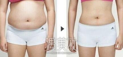 武汉,卓美,吸脂