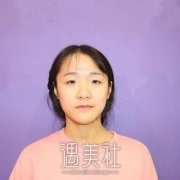 105医院整形美容科双眼皮怎么样?案例对比分享~ width=