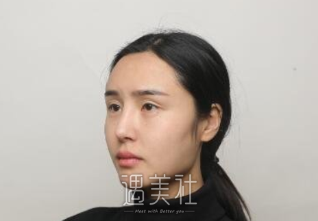 韩勋,修复双眼皮