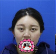 熊宜文做鼻子垃圾吗 案例 width=