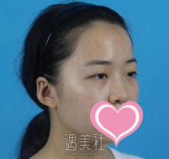 王美水双眼皮案例：眼睛看上去大了很多 width=