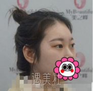 海峡医院郭栋双眼皮案例 width=