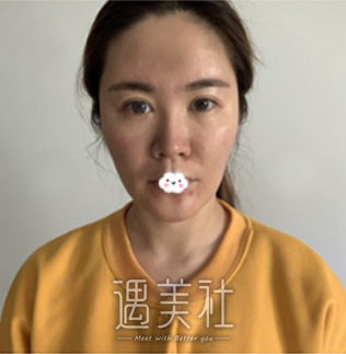 玻尿酸隆鼻后遗症王祚轩整形失败案例图片 恢复了之前白皙的状 玻尿酸隆鼻后遗症王祚轩整形失败案例图片 恢复了之前白皙的状