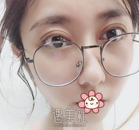 车红昌双眼皮案例