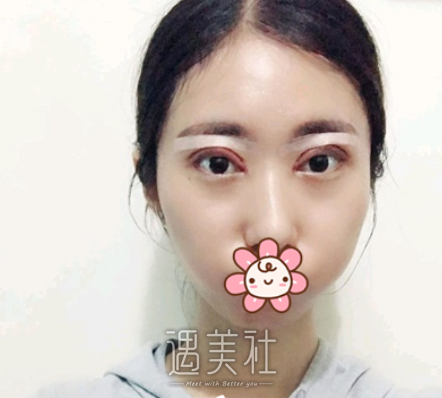 车红昌双眼皮案例