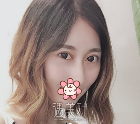车红昌双眼皮案例