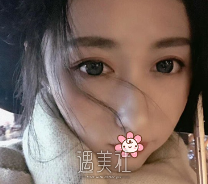 车红昌双眼皮案例