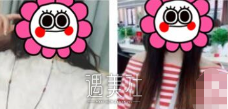 谢卫国假体隆胸案例