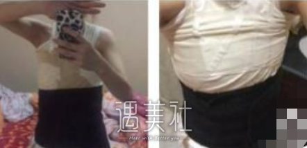 谢卫国假体隆胸案例