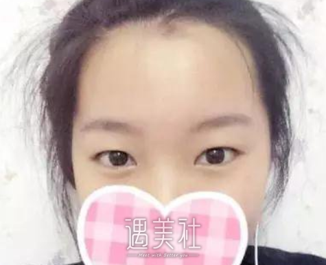 杨亚益定制帕克法双眼皮案例