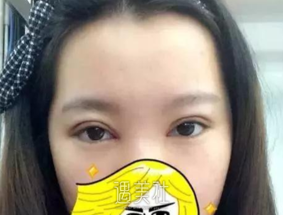 杨亚益定制帕克法双眼皮案例