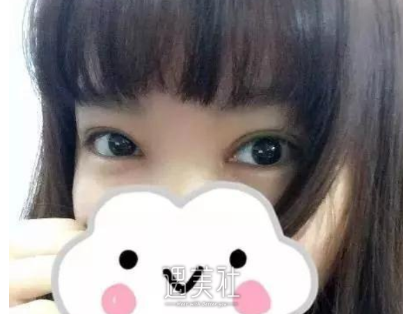 杨亚益定制帕克法双眼皮案例