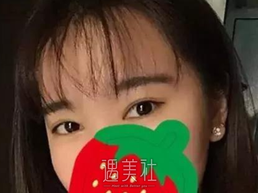玉之光刘中国双眼皮怎么样？案例分享～