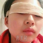 许扬滨医生双眼皮案例分享||气质瞬间提升! width=