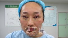 宋桂霞实力怎么样?宋桂霞双眼皮案例展示～ width=
