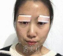 盘锦玉丽有整形失败案例吗?真实双眼皮整形案例一览~ width=