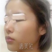 胡志奇双眼皮实力怎么样?真实案例一览~ width=