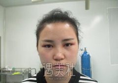 洪星杓医生实力怎么样?真实双眼皮案例一览~ width=