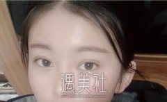 毛大夫普潇做的双眼皮怎么样?案例分享～ width=