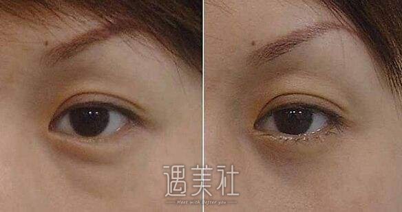 卿勇去眼袋案例