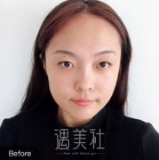 泰安当代整形美容医院失败案例|双眼皮果分享~ width=