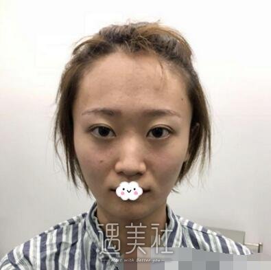 武汉亚太整形双眼皮案例：画什么眼妆都好看~ width=