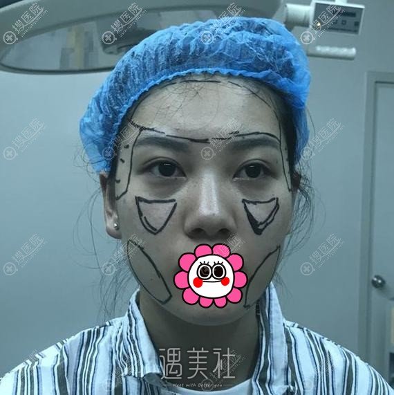 厦门华美陈运生自体脂肪填充额头案例，不错哦~