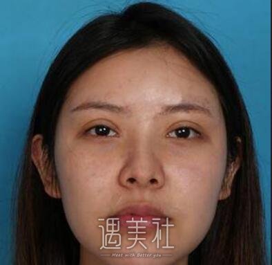 张勍枫隆鼻失败修复案例 术后三个月了 怎么样 好不好 价格表 多少钱 电话 隆鼻手术 隆鼻整形价格 医院医生 美鼻社 张勍枫隆鼻失败修复案例 术后三个月了 怎么样 好不好 价格表 多少钱 电话 隆鼻手术 隆鼻整形价格 医院医生 美鼻社