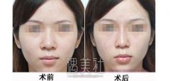 缩小鼻翼案例公开｜圆我美丽翘鼻梦 width=