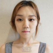 假体隆鼻后鼻子容易被碰歪吗? width=