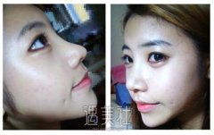 假体隆鼻后碰到鼻子会出问题吗? width=