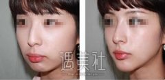 假体隆鼻后为什么会出现穿孔呢? width=