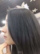 假体隆鼻术后多久能恢复? width=