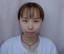 李婧君双眼皮案例展示｜亲身改变全过程分享｜内含果图