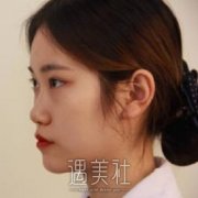 宫风勇医生做鼻子好吗？果好不好？附隆鼻案例果图 width=