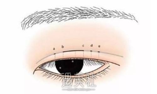 郑州赵绛波割双眼皮怎么样？医生实力及案例一览 width=