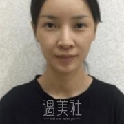 上海九院魏皎鼻整形案例，真人恢复全过程对比图片参考 width=