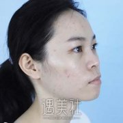 上海九院张余光拉皮案例，65天美图分享，年轻不少 width=