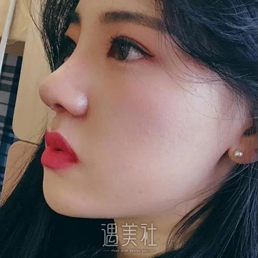 上海李鸿君做鼻修复技术怎么样？医生实力及案例公布 width=