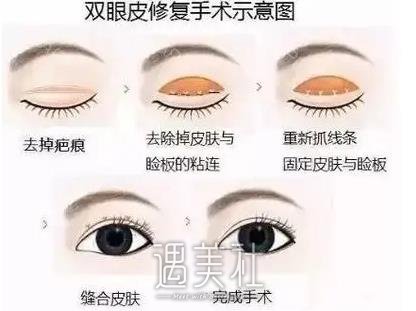 南京陈小剑双眼皮修复价格贵吗？2022收费表及案例一览 width=