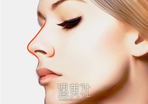 宁波郭光烨隆鼻风格公开｜内附亲身体验果图 width=