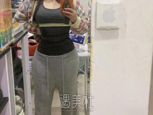 广州黄广香腰腹吸脂案例公开｜医生实力及果图分享 width=