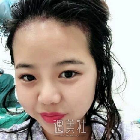 重庆新沐发际线种植果公开｜内附体验果图 width=
