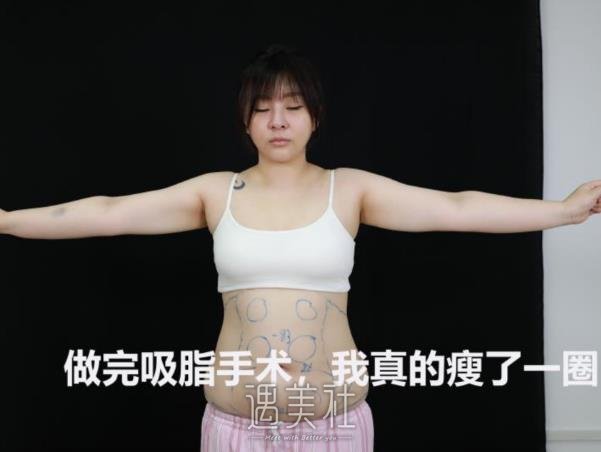 2022成都卫东医生吸脂案例公开｜前后对比让人惊讶 width=