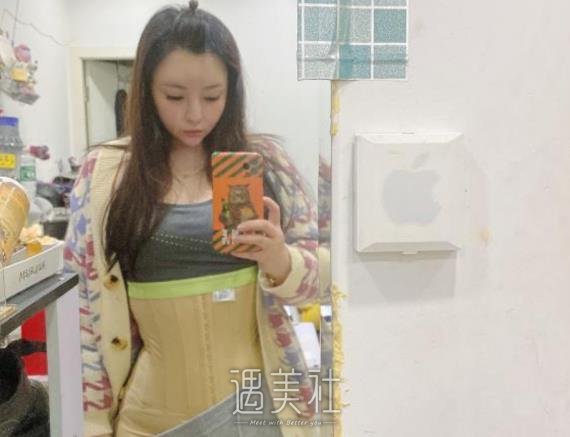 郑州李正斌医生吸脂案例公开｜2022亲身体验果图一览 width=