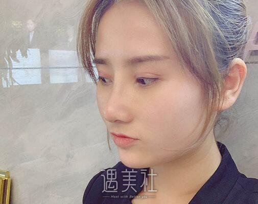 南京刘博医生割双眼皮价格贵吗？2022价格表及案例分享 width=