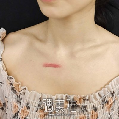 西安宋保强医生瘢痕修复案例公布｜内含体验果图 width=