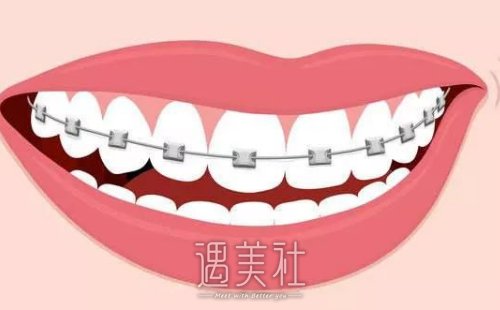 北京陈美占医生牙齿正畸案例公布｜前后对比图抢先一览 width=