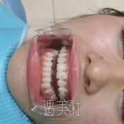 天包地长什么样？天包地矫正后脸型变化图展示 width=