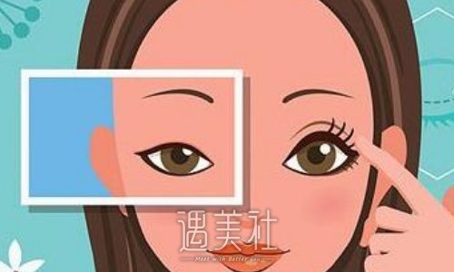 北京郭建玲双眼皮价格明细展示｜内附全新整形案例 width=